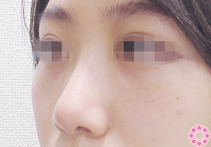 年代：20代 施術名：プチ隆鼻術（ヒアルロン酸） 施術後｜【公式】東京形成美容外科