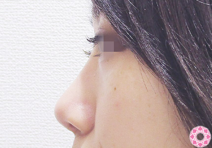 年代：20代 施術名：プチ隆鼻術（ヒアルロン酸） 施術後｜【公式】東京形成美容外科