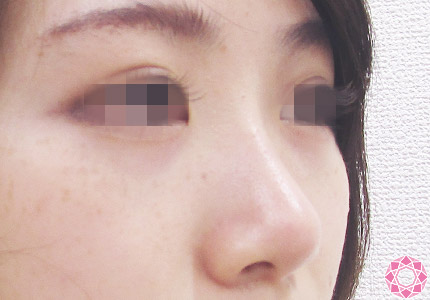 年代：20代 施術名：プチ隆鼻術（ヒアルロン酸） 施術後｜【公式】東京形成美容外科