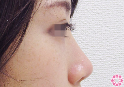 年代：20代 施術名：プチ隆鼻術（ヒアルロン酸） 施術後｜【公式】東京形成美容外科