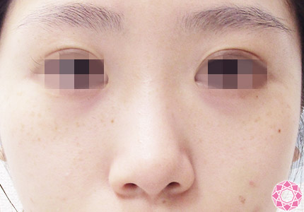 年代：20代 施術名：プチ隆鼻術（ヒアルロン酸） 施術前｜【公式】東京形成美容外科