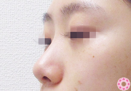 年代：20代 施術名：プチ隆鼻術（ヒアルロン酸） 施術前｜【公式】東京形成美容外科