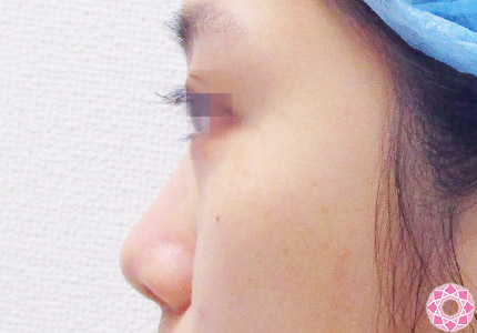 年代：20代 施術名：プチ隆鼻術（ヒアルロン酸） 施術前｜【公式】東京形成美容外科