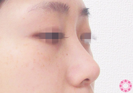 年代：20代 施術名：プチ隆鼻術（ヒアルロン酸） 施術前｜【公式】東京形成美容外科