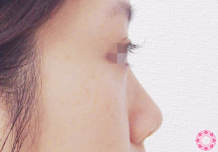 年代：20代 施術名：プチ隆鼻術（ヒアルロン酸） 施術前｜【公式】東京形成美容外科