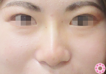 年代：20代 施術名：プチ隆鼻術（ヒアルロン酸） 施術後｜【公式】東京形成美容外科