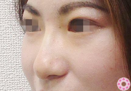 年代：20代 施術名：プチ隆鼻術（ヒアルロン酸） 施術後｜【公式】東京形成美容外科