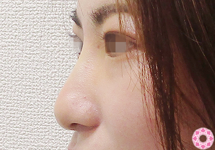 年代：20代 施術名：プチ隆鼻術（ヒアルロン酸） 施術後｜【公式】東京形成美容外科