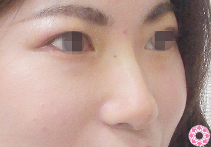 年代：20代 施術名：プチ隆鼻術（ヒアルロン酸） 施術後｜【公式】東京形成美容外科