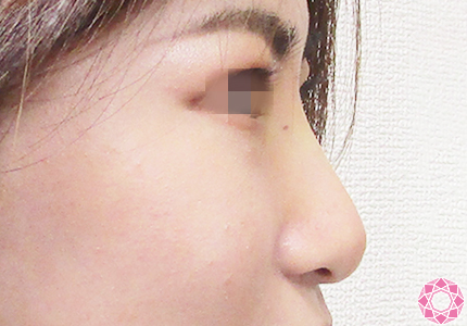 年代：20代 施術名：プチ隆鼻術（ヒアルロン酸） 施術後｜【公式】東京形成美容外科
