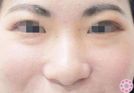 年代：20代 施術名：プチ隆鼻術（ヒアルロン酸） 施術前｜【公式】東京形成美容外科
