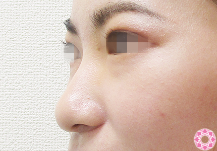 年代：20代 施術名：プチ隆鼻術（ヒアルロン酸） 施術前｜【公式】東京形成美容外科