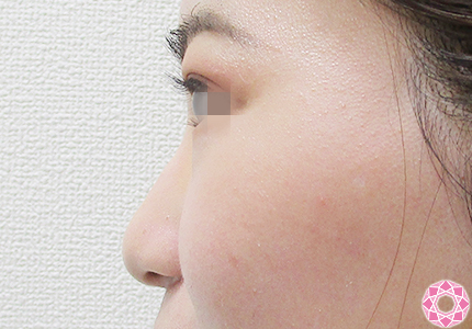 年代：20代 施術名：プチ隆鼻術（ヒアルロン酸） 施術前｜【公式】東京形成美容外科