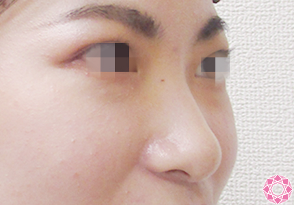 年代：20代 施術名：プチ隆鼻術（ヒアルロン酸） 施術前｜【公式】東京形成美容外科