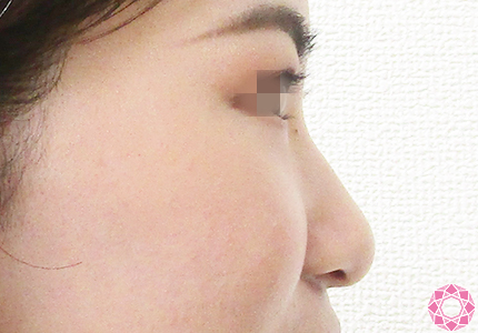 年代：20代 施術名：プチ隆鼻術（ヒアルロン酸） 施術前｜【公式】東京形成美容外科