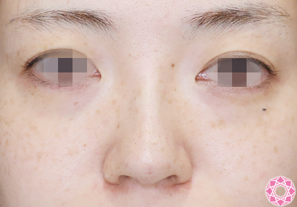 年代：30代 施術名：プチ隆鼻術（ヒアルロン酸） 施術後｜【公式】東京形成美容外科