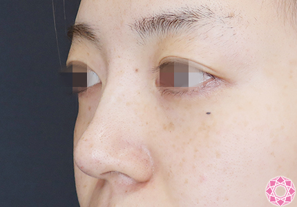 年代：30代 施術名：プチ隆鼻術（ヒアルロン酸） 施術後｜【公式】東京形成美容外科