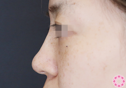 年代：30代 施術名：プチ隆鼻術（ヒアルロン酸） 施術後｜【公式】東京形成美容外科