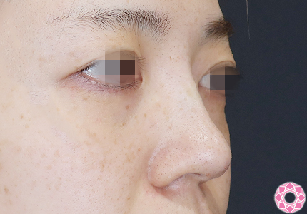 年代：30代 施術名：プチ隆鼻術（ヒアルロン酸） 施術後｜【公式】東京形成美容外科