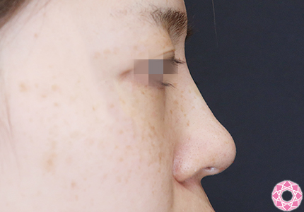 年代：30代 施術名：プチ隆鼻術（ヒアルロン酸） 施術後｜【公式】東京形成美容外科