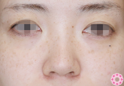 年代：30代 施術名：プチ隆鼻術（ヒアルロン酸） 施術前｜【公式】東京形成美容外科