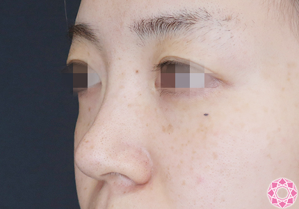 年代：30代 施術名：プチ隆鼻術（ヒアルロン酸） 施術前｜【公式】東京形成美容外科