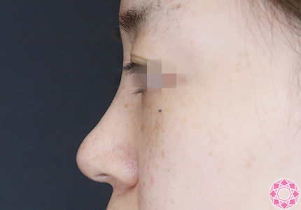 年代：30代 施術名：プチ隆鼻術（ヒアルロン酸） 施術前｜【公式】東京形成美容外科