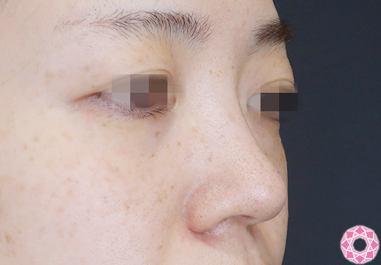 年代：30代 施術名：プチ隆鼻術（ヒアルロン酸） 施術前｜【公式】東京形成美容外科