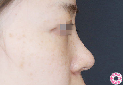 年代：30代 施術名：プチ隆鼻術（ヒアルロン酸） 施術前｜【公式】東京形成美容外科