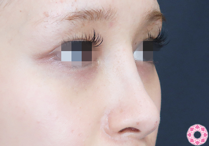 年代：20代 施術名：プチ隆鼻術（ヒアルロン酸） 施術後 拡大画像｜【公式】東京形成美容外科