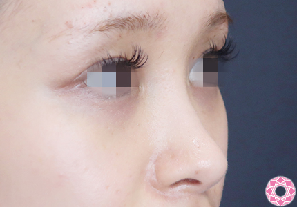 年代：20代 施術名：プチ隆鼻術（ヒアルロン酸） 施術前 拡大画像｜【公式】東京形成美容外科