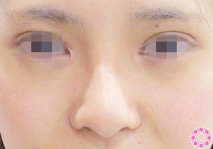 年代：20代 施術名：隆鼻術（シリコンプロテーゼ） 施術後｜【公式】東京形成美容外科