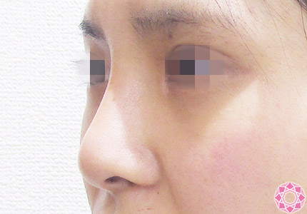 年代：20代 施術名：隆鼻術（シリコンプロテーゼ） 施術後｜【公式】東京形成美容外科