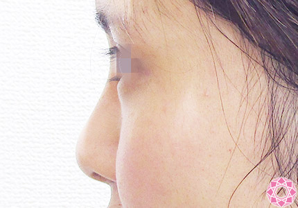 年代：20代 施術名：隆鼻術（シリコンプロテーゼ） 施術後｜【公式】東京形成美容外科