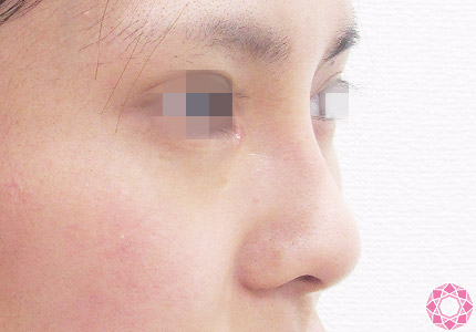 年代：20代 施術名：隆鼻術（シリコンプロテーゼ） 施術後｜【公式】東京形成美容外科