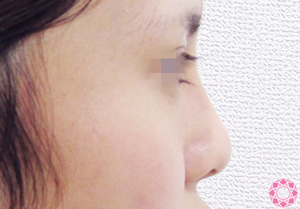 年代：20代 施術名：隆鼻術（シリコンプロテーゼ） 施術後｜【公式】東京形成美容外科