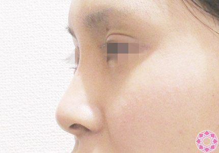 年代：20代 施術名：隆鼻術（シリコンプロテーゼ） 施術前｜【公式】東京形成美容外科