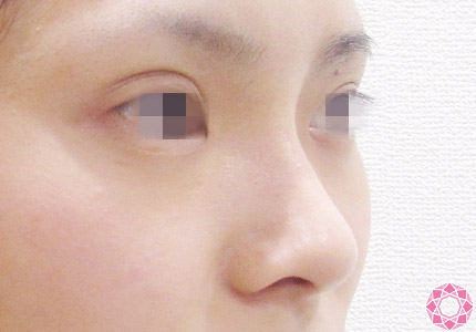 年代：20代 施術名：隆鼻術（シリコンプロテーゼ） 施術前｜【公式】東京形成美容外科