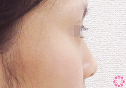 年代：20代 施術名：隆鼻術（シリコンプロテーゼ） 施術前｜【公式】東京形成美容外科