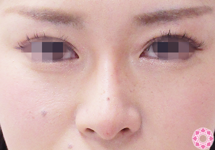 年代：20代 施術名：プチ隆鼻術（ヒアルロン酸） 施術後｜【公式】東京形成美容外科