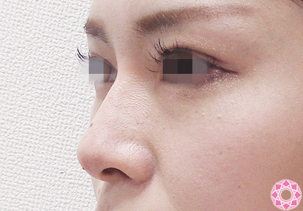 年代：20代 施術名：プチ隆鼻術（ヒアルロン酸） 施術後｜【公式】東京形成美容外科