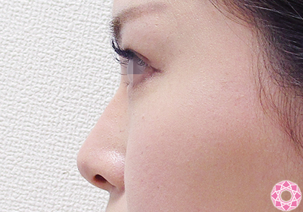 年代：20代 施術名：プチ隆鼻術（ヒアルロン酸） 施術後｜【公式】東京形成美容外科