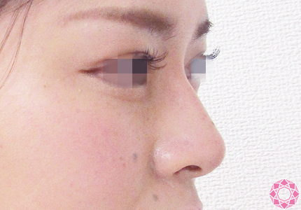 年代：20代 施術名：プチ隆鼻術（ヒアルロン酸） 施術後｜【公式】東京形成美容外科