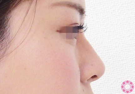 年代：20代 施術名：プチ隆鼻術（ヒアルロン酸） 施術後｜【公式】東京形成美容外科