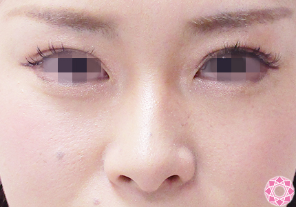 年代：20代 施術名：プチ隆鼻術（ヒアルロン酸） 施術前｜【公式】東京形成美容外科