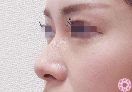 年代：20代 施術名：プチ隆鼻術（ヒアルロン酸） 施術前｜【公式】東京形成美容外科