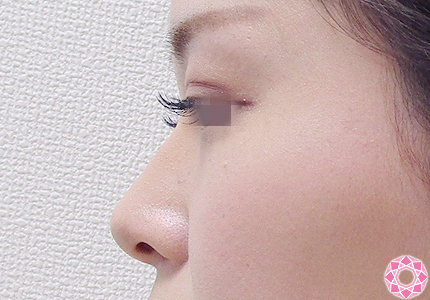 年代：20代 施術名：プチ隆鼻術（ヒアルロン酸） 施術前｜【公式】東京形成美容外科