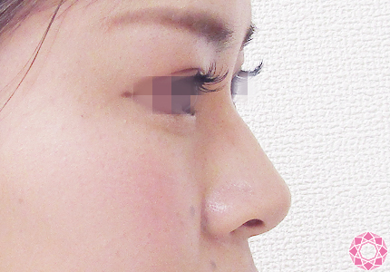年代：20代 施術名：プチ隆鼻術（ヒアルロン酸） 施術前｜【公式】東京形成美容外科