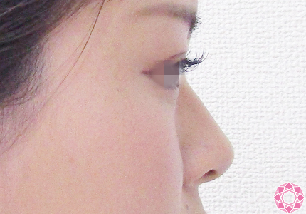 年代：20代 施術名：プチ隆鼻術（ヒアルロン酸） 施術前｜【公式】東京形成美容外科