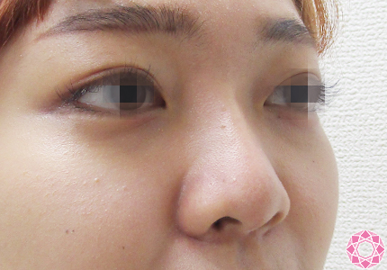 年代：20代 施術名：プチ隆鼻術（ヒアルロン酸） 施術後 拡大画像｜【公式】東京形成美容外科